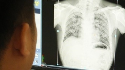 Vụ bụi phổi ở Nghệ An: Công ty thiếu trách nhiệm với tính mạng, sức khỏe người lao động