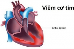 Bệnh viêm cơ tim - Nguyên nhân, triệu chứng, chẩn đoán và điều trị
