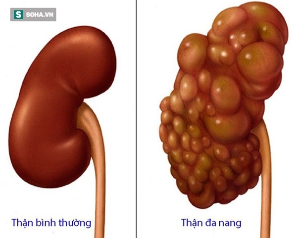 Muốn cho thận khỏe mạnh cần phải chăm sóc đúng cách