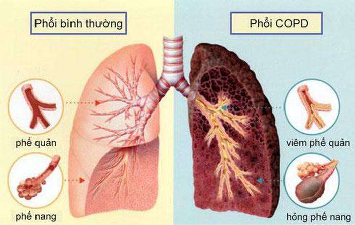 benh phoi tac nghen can benh khong khac gi ung thu phoi