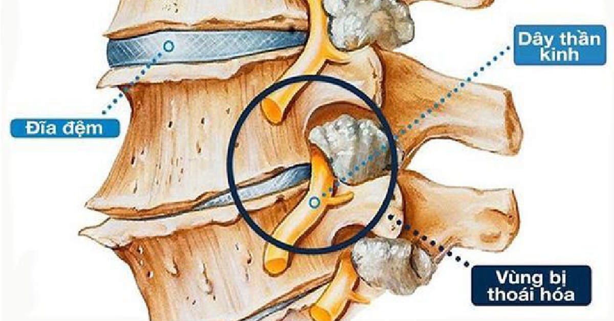 Bệnh cột sống, bệnh thường gặp của những công nhân phải đứng nhiều