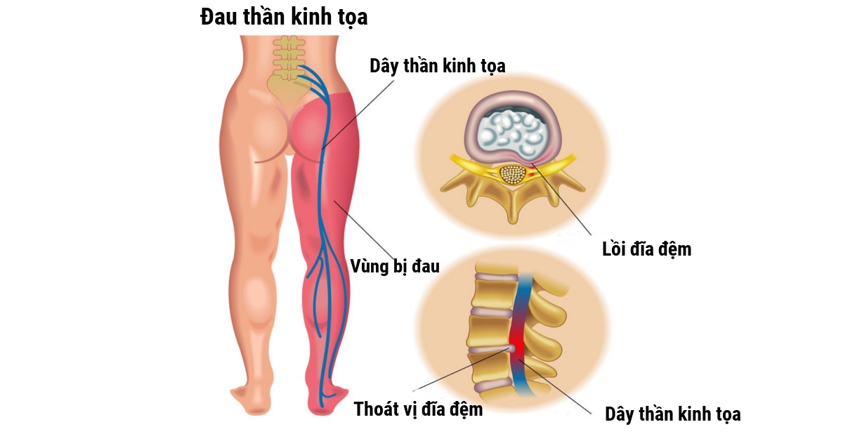 Bệnh cột sống, bệnh thường gặp của những công nhân phải đứng nhiều