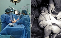 Kỳ lạ: Bé trai chào đời có 6 vòng dây rốn quấn chặt