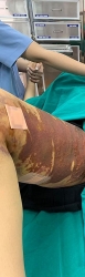 Thêm một nữ bệnh nhân bị tai biến khi hút mỡ tại thẩm mỹ viện Việt Hàn