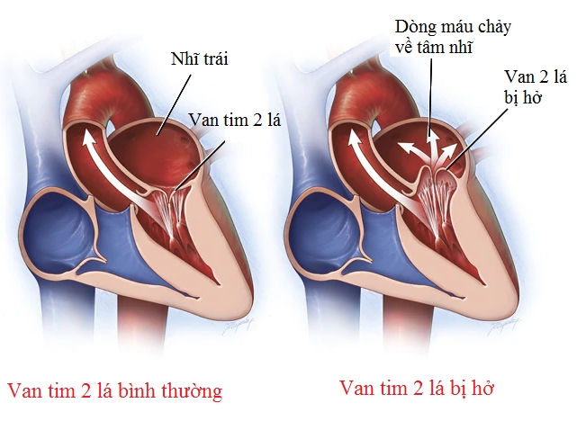 Hở van tim 2 lá và các biến chứng nguy hiểm cần biết