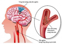 Mách bạn cách ngừa tai biến, đột quỵ mùa lạnh đúng