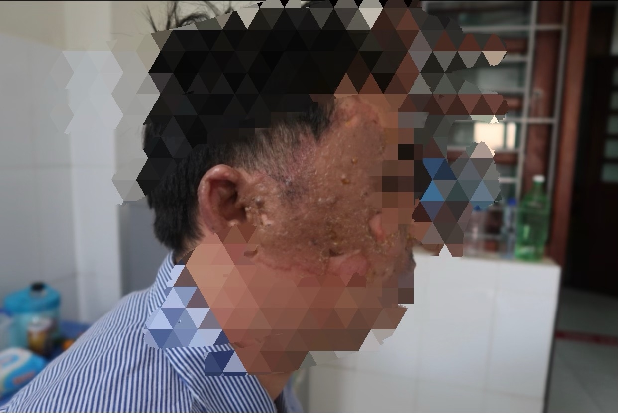 Vụ cháy KCN Vân Trung: Trách nhiệm của doanh nghiệp với công nhân bị thương ra sao?